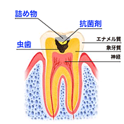 虫歯治療の図