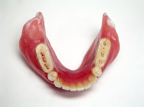 リハビリテーション用の入れ歯