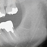 予防的抜歯症例